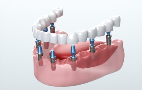 Главные плюсы имплантации зубов в проверенной клинике